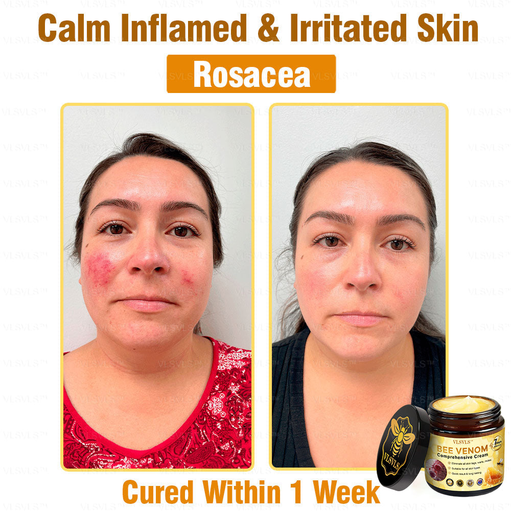 VLSVLS™ Bee Venom Comprehensive Cream (Suitable for all ages & TGA recommends)🔥🔥